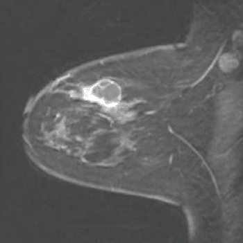 Image: Microwave Tomography imaging can be used to monitor how well treatment for breast cancer is working (Photo courtesy of Paul M. Meaney).